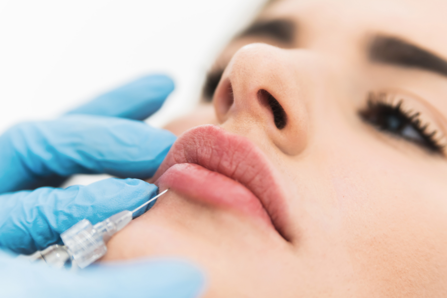 ¿Cuánto dura el aumento de labios con ácido hialurónico?